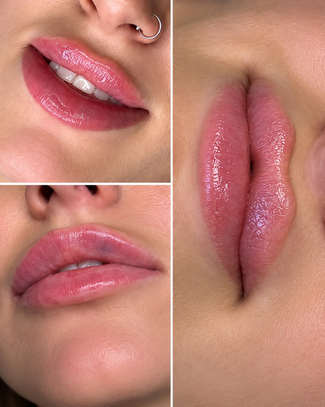 Lip treatment result