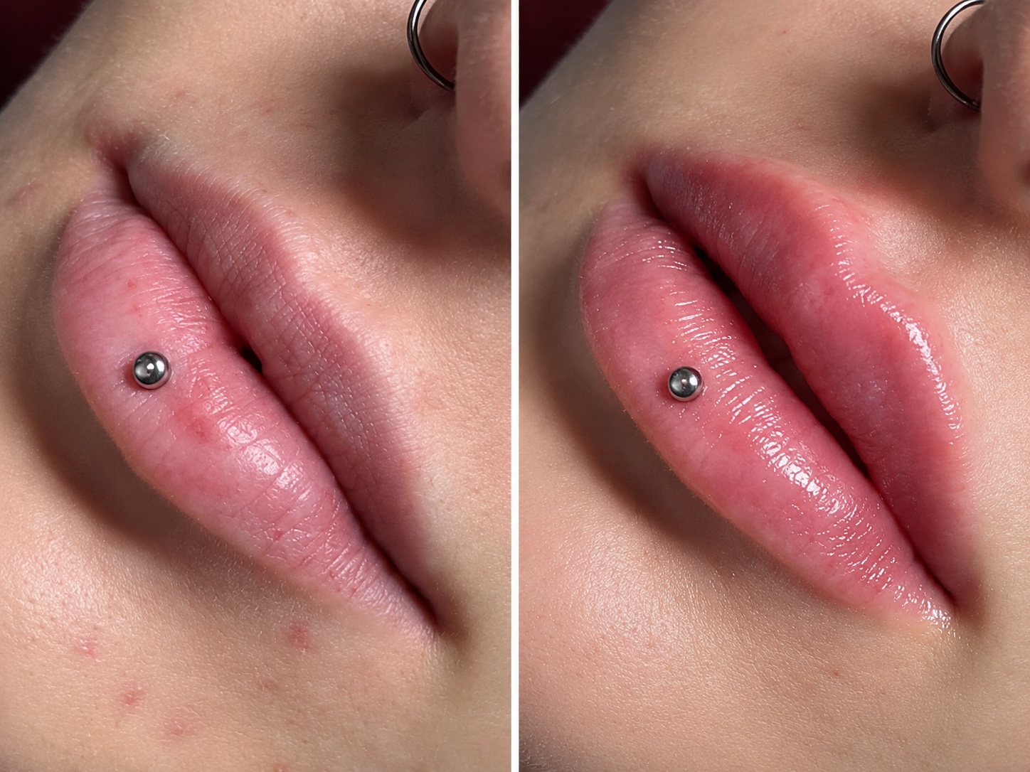 Lip treatment result