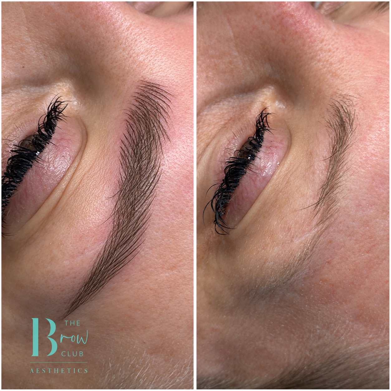 Brow treatment result