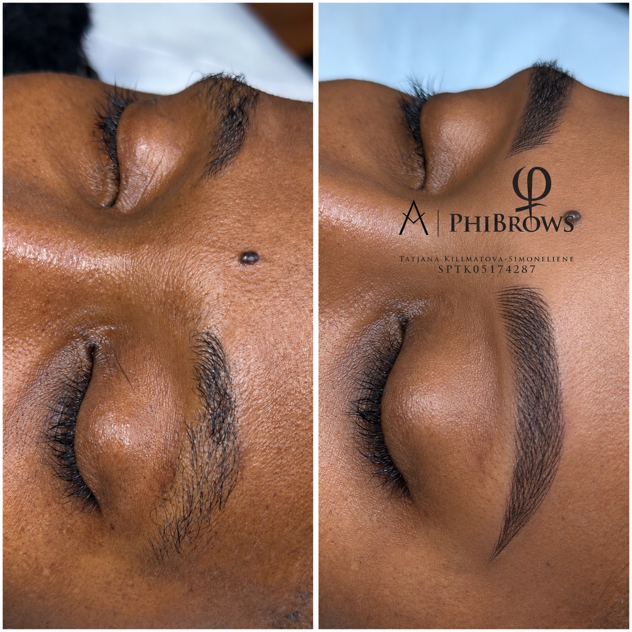 Brow treatment result