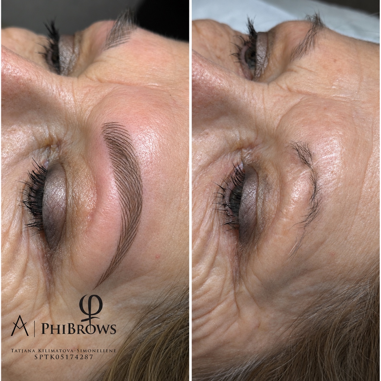 Brow treatment result